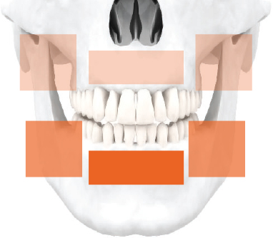 Zobu Implanti to stiprinājums kaulā